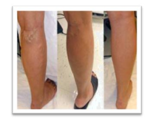 Varicose Veins Treatment: What Should You Expect? - Worcester